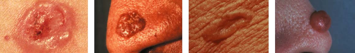 Four different photos of Basal Cell Carcinoma (BCC) skin cancer.