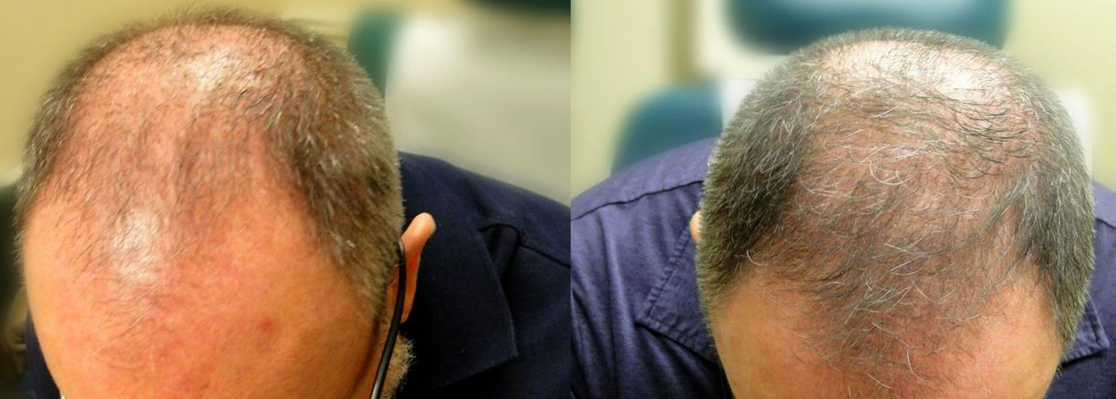 Crown hair transplant before and after photo.