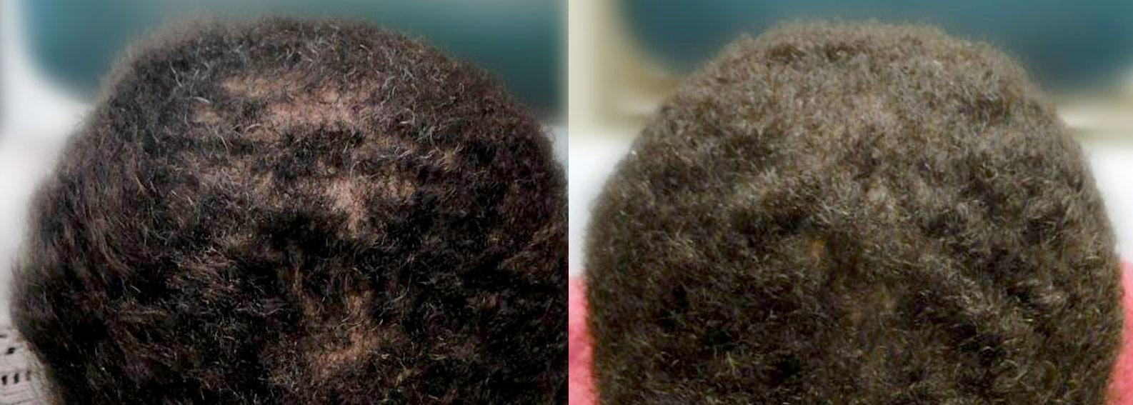 Before (left) & after (right) photo of an ethnic hair transplant.