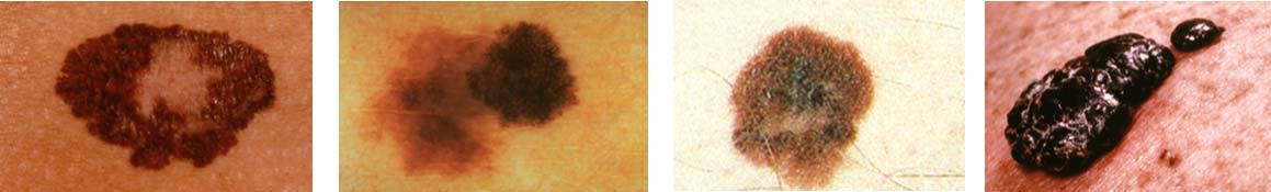 Four photos showing different variations of Melanoma skin cancer