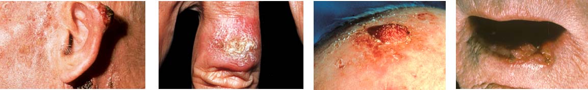 Four photos showing Squamous Cell Carcinoma skin cancer