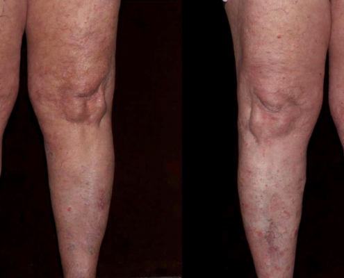 Spider Veins Before & After