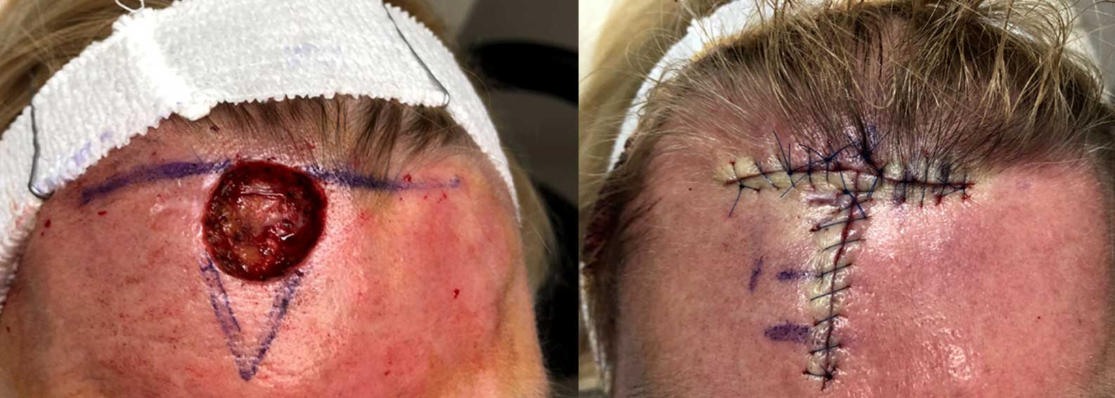 Before and after of Mohs skin cancer surgery on a woman's forehead.