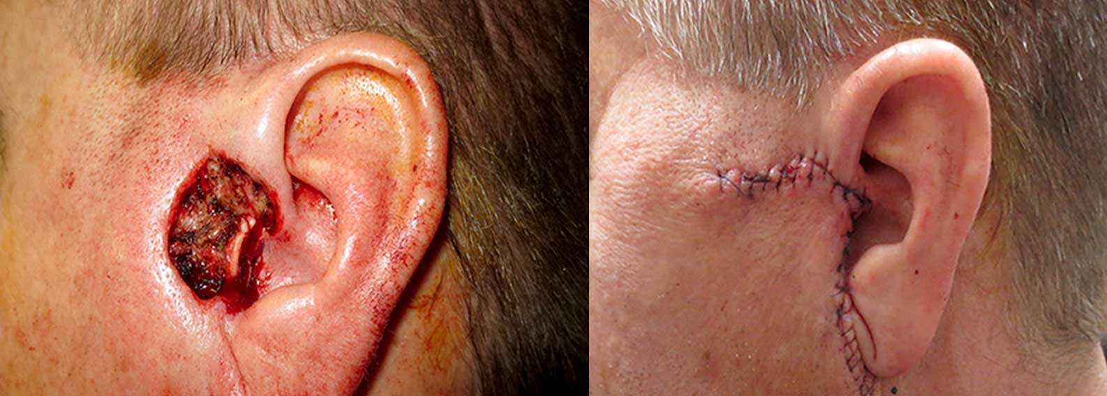 Before and after of Mohs skin cancer surgery on a patients ear.