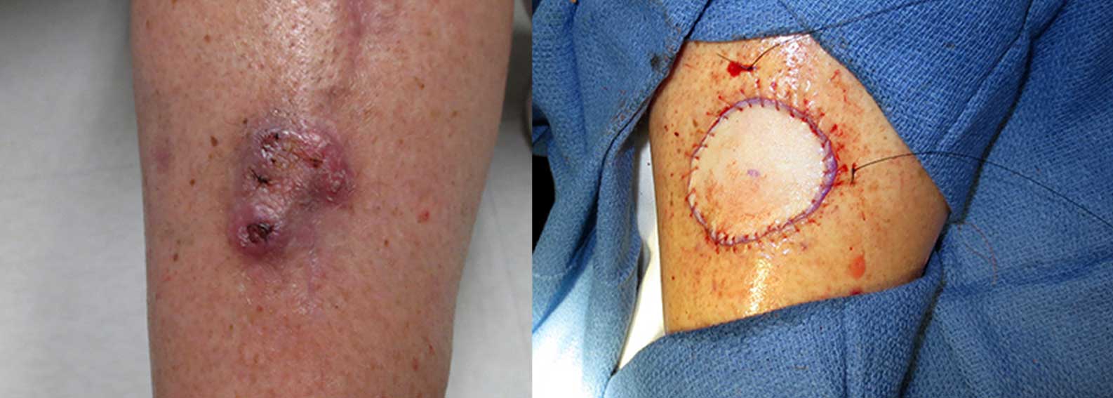 Before and after of skin cancer removal on a leg with skin graft.