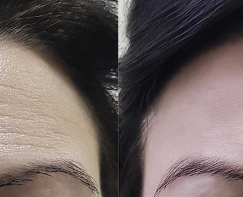 Woman's forehead with wrinkles before Botox and none after Botox