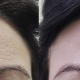 Woman's forehead with wrinkles before Botox and none after Botox