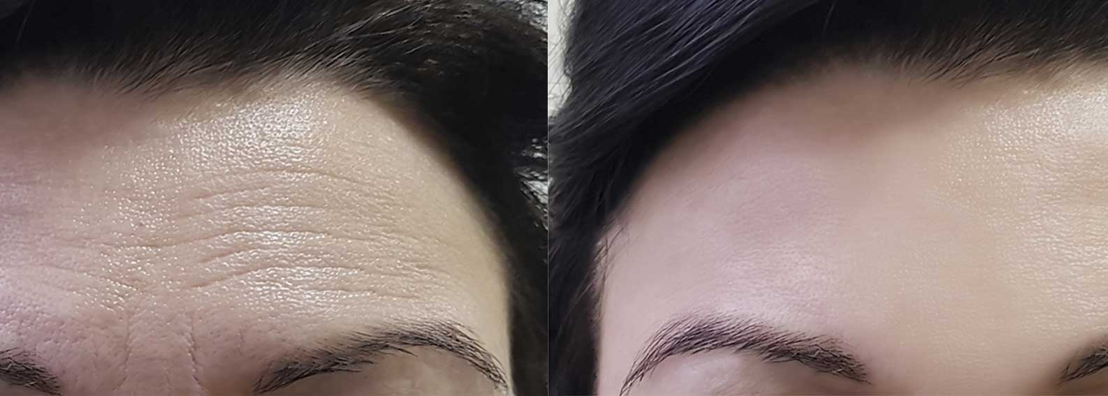 Woman's forehead with wrinkles before Botox and none after Botox