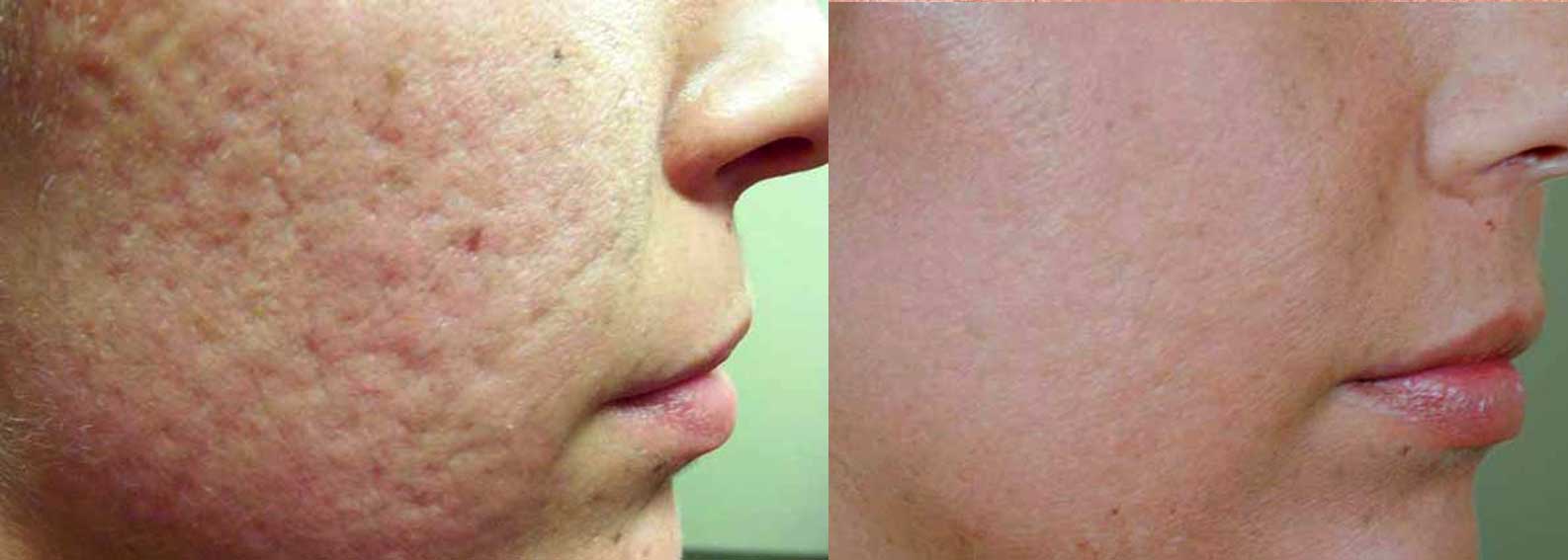 price skin treatment & Photos Dermatology After  Cosmetic Before Treatment