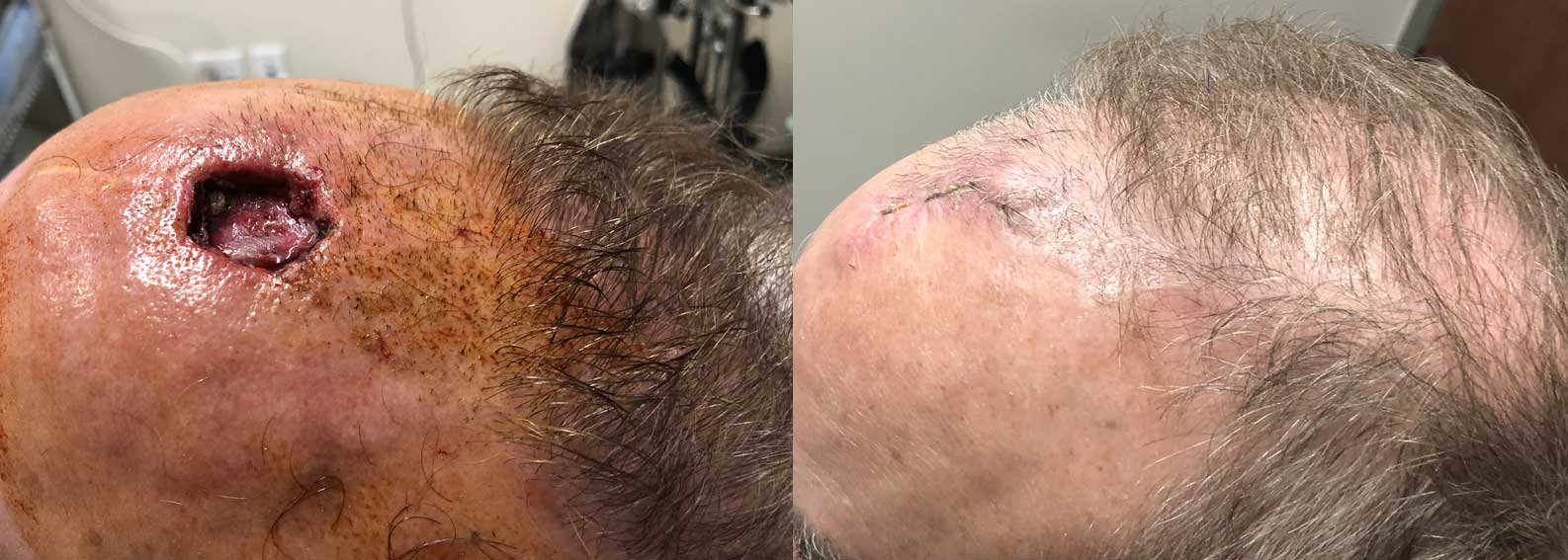 Before & after of Skin cancer Surgery