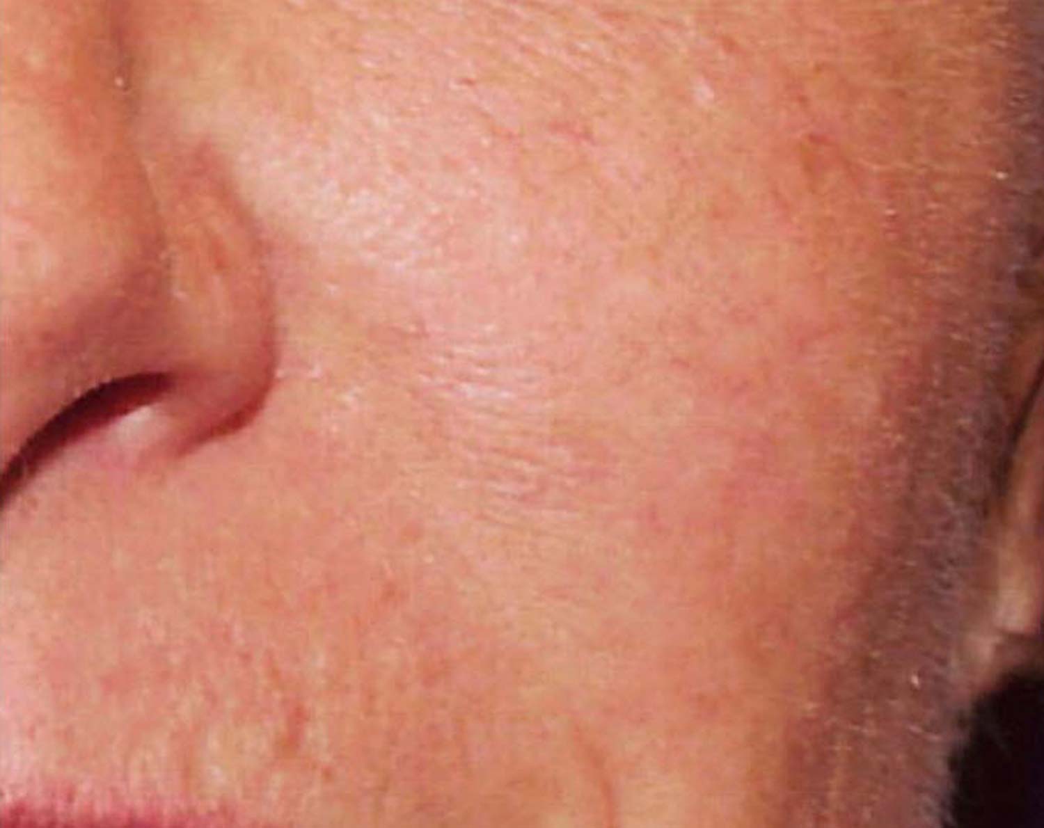 Spider veins on a patients face are completely gone after laser treatment. Spider veins on a patients face are completely gone after laser treatment.