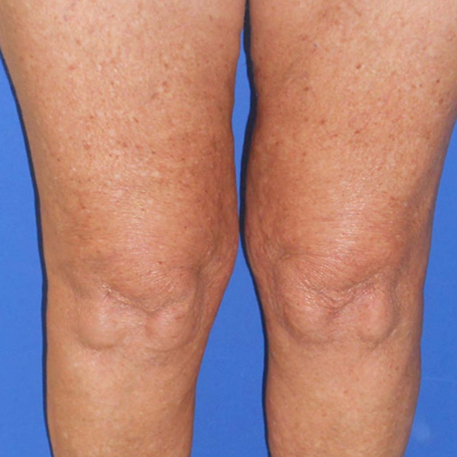 Spider veins on a patients legs are gone after surgery. Spider veins on a patients legs are gone after surgery.