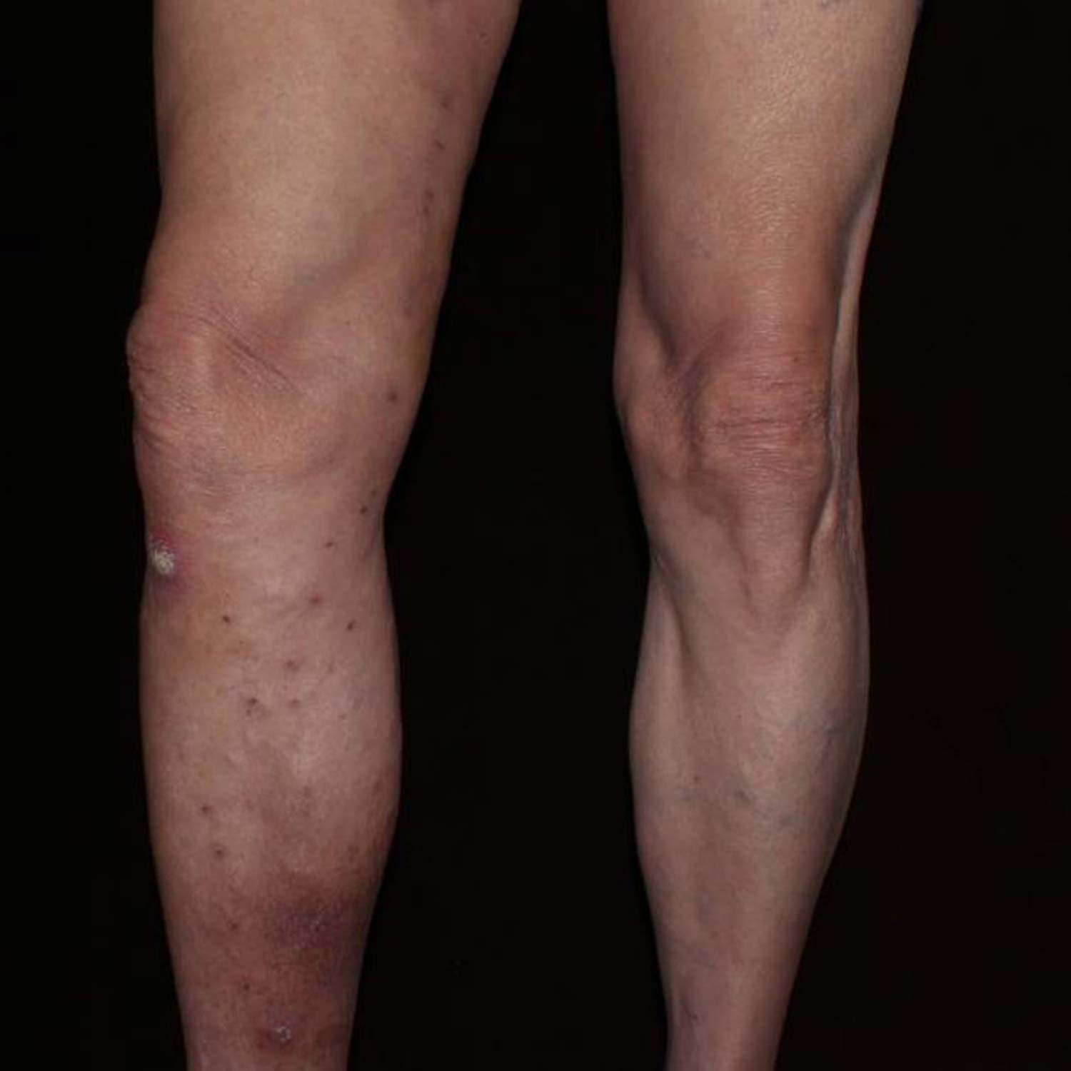 Varicose Vein after surgery is gone. Varicose Vein after surgery is gone.