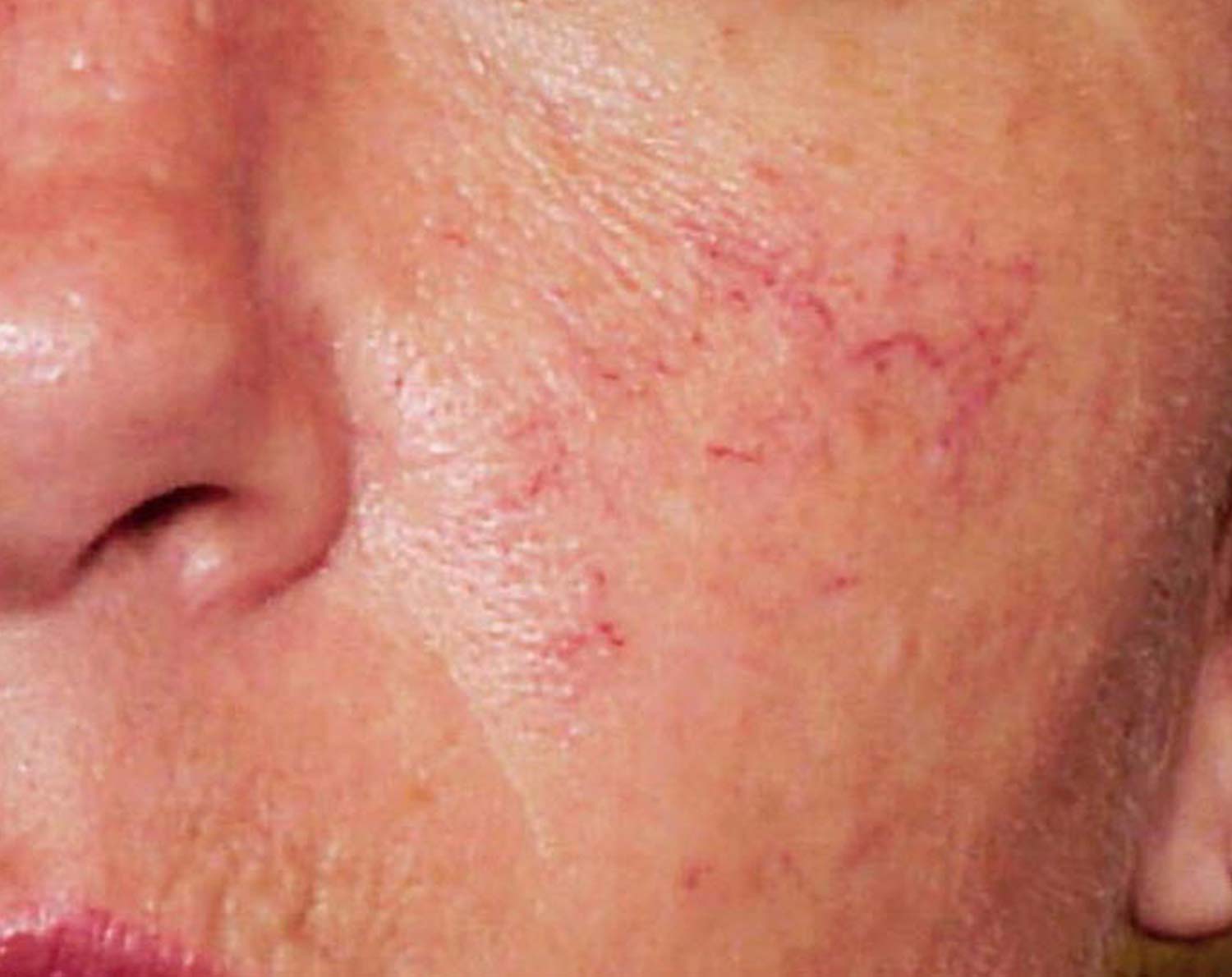 Spider veins on a patients face before laser treatment. Spider veins on a patients face before laser treatment.