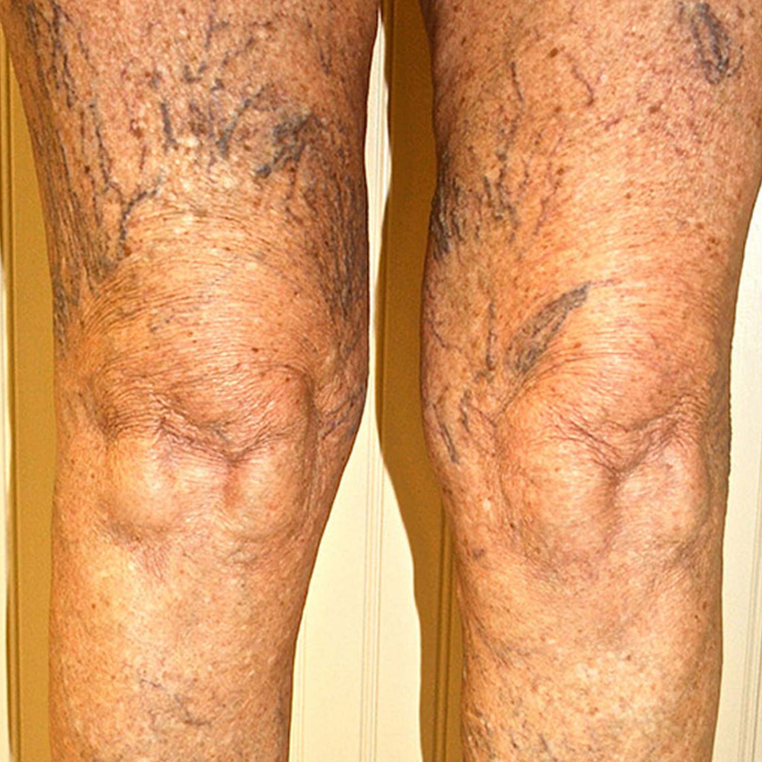 Spider veins on a patients legs before surgery. Spider veins on a patients legs before surgery.