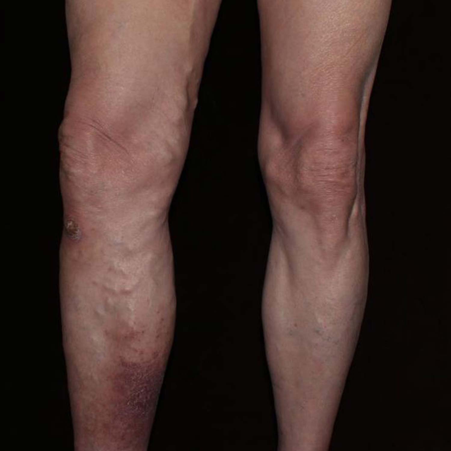Varicose Vein before surgery. Varicose Vein before surgery.