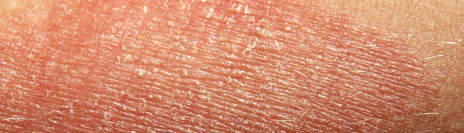 Eczema Total Skin Center