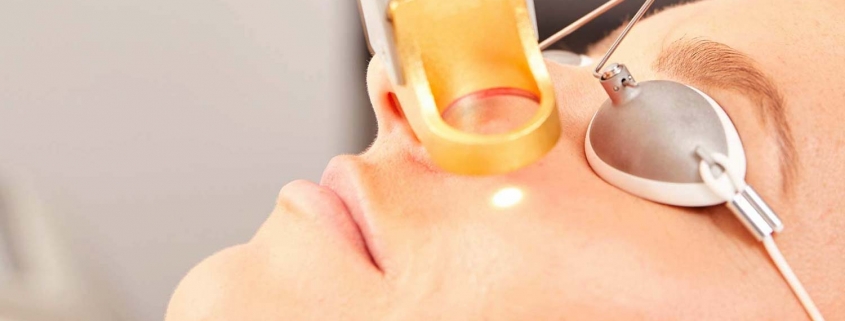 Spider Veins being removed from a females face with laser treatment